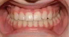 Teeth Alignment After Treatment 
