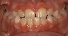 Teeth Alignment Before Treatment