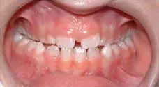 Teeth Alignment Before Treatment