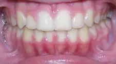Teeth Alignment After Treatment 