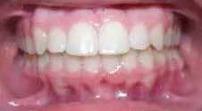 Teeth Alignment After Treatment 