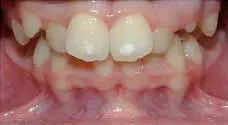 Teeth Alignment Before Treatment