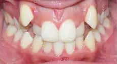 Teeth Alignment Before Treatment