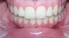 Teeth Alignment After Treatment 