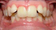 Teeth Alignment Before Treatment