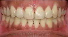 Teeth Alignment After Treatment 