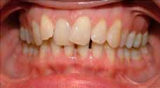 Teeth Alignment Before Treatment